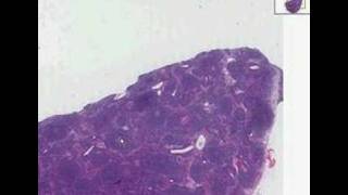 Histopathology Lymph nodeMantle cell lymphoma [upl. by Ziladnerb724]