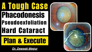 An encounter with a difficult case Weak Zonules Hypermature Dense Cataract Limited Mydriasis [upl. by Neumeyer]