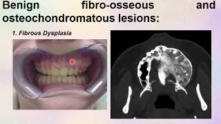 Non odontogenic tumors  DR NOOR SAHBAN FOURTH GRADE [upl. by Juli]