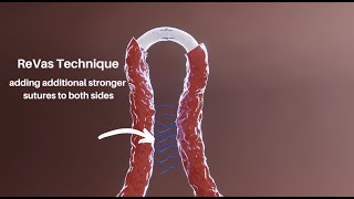 Vasectomy Reversal REinforcing VAsal Suture ReVas Technique [upl. by Renruojos1]