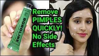 Remove PIMPLES amp ACNE IN 3 DAYS  NATURAL amp EASY METHOD [upl. by Pazice700]