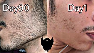 Minoxidil beard journey  3 months INSANE results [upl. by Narmi]