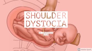 SHOULDER DYSTOCIAUnit8 OBG Abnormal Labour [upl. by Ender701]