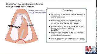 Septoplasty [upl. by Ackerman]