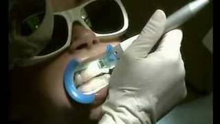 Laser Whitening [upl. by Kaycee]