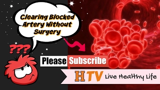 Clearing Blocked Artery Without Surgery  Blocked Artery [upl. by Denn]