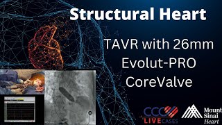 TAVR with 26mm EvolutPRO CoreValve  May 8 2018 [upl. by Marlene]