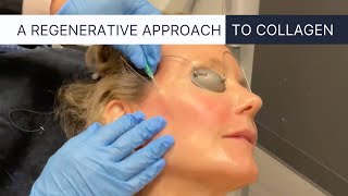 PDO Thread Lift the Ultimate NonSurgical Facelift [upl. by Abramson]