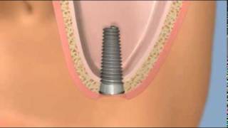 Operatie de sinus lifting [upl. by Gregrory426]