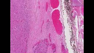 Histopathology ThyroidFollicular carcinoma [upl. by Isobel]