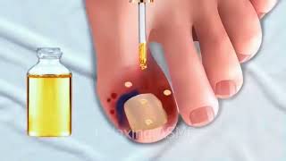 ASMR Best Treatment of removing Toe nails [upl. by August]