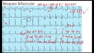 Ejemplo Bloqueo Bifascicular [upl. by Aziar843]