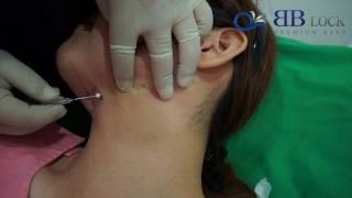 BBLock Thread Lifting for neck amp Double Chin [upl. by Catherina]