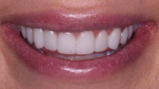 Um Prótese Dentária de Silicone Removível Fixa Bem e Fica Perfeita [upl. by Eadie]