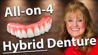 Fixed Denture  Hybrid Denture  Allon4 Dental Implants [upl. by Melone]