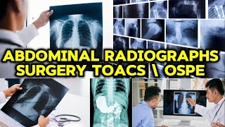 Abdomen x rays radiographs  surgery toacs ospe  mbbsmedico3814 [upl. by Mlohsihc]