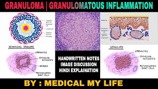 GRANULOMA  GRANULOMATOUS INFLAMMATION  Types Of Chronic Inflammation [upl. by Ahsekan791]