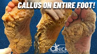 SHAVING CALLUS ON ENTIRE SOLE OF FOOT Dr Nick Campitelli Foot amp Ankle Surgeon [upl. by Elyrrad733]