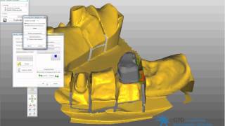 passerelle 3shape exocad telescope [upl. by Ferwerda9]