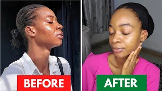 25 DAYS SKIN TRANSFORMATION USING TRETINOINHow Tretinoin saved my Skin Before amp After drpurity [upl. by Greeley]