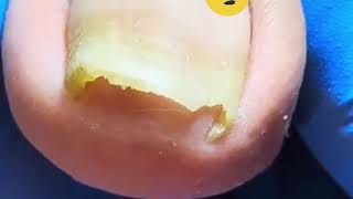 Cut Dirty Ingrown Toenail 剪大脏向内生长脚趾甲 shorts video health [upl. by Letty]