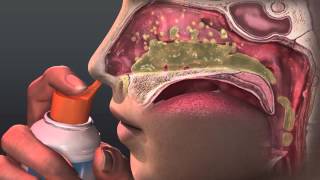 Can Saline Irrigation Help Nasal Allergies Animated Guide to Saline Nasal Irrigation [upl. by Pollock]