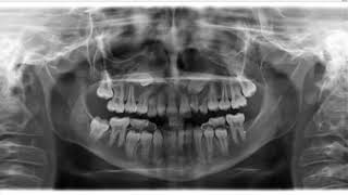 Impacted canines and congenitally missing wisdom teeth and 18 on panoramic radiograph [upl. by Krongold]