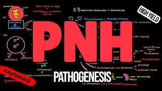 Paroxysmal Nocturnal Hemoglobinuria Pathogenesis Symptoms Diagnosis Treatment [upl. by Kenwood]