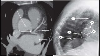 ChestampCardiac Radiologyanatomy3with answers CTMRIchestxrayfrcrquiezrdaiopediatipsexams [upl. by Ax]