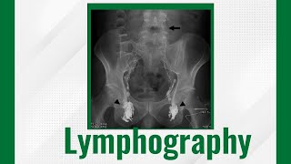 Lymphography Lymphangiography Techniques And Uses Lymphangiogram Purpose Procedure And Risks [upl. by Bael987]