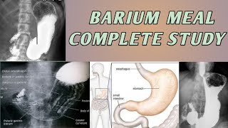 Barium Meal Complete Study Of Stomach [upl. by Nosro]