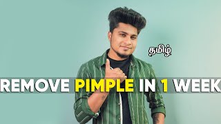 HOW TO REMOVE PIMPLE PERMANENTLY  IN TAMIL  SARAN LIFESTYLE [upl. by Aener]