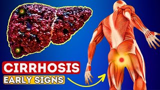 12 Early Signs of Liver CIRRHOSIS  LIVER is DYING [upl. by Baecher572]