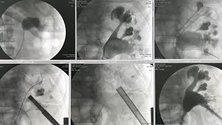 PCNL of staghorn renal stone [upl. by Barabbas]