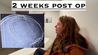 My experience so far 2 weeks after craniotomy surgery for removal of a brain tumor Part 4 [upl. by Bruyn]