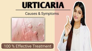 Urticaria treatment  Hives causes symptoms prevention and treatment [upl. by Abihsat]