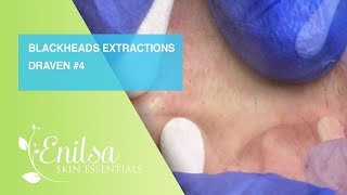 Blackheads Extractions Draven 4th Treatment [upl. by Nesilla]