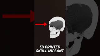 3D Printing the Worlds MOST COMPLICATED Medical Device [upl. by Enyahc]