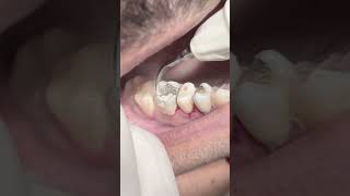 Scaling and cleaning tartar amp calculus dentistteeth dentist satisfying [upl. by Rabelais619]