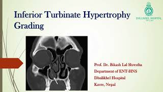 Inferior turbinate hypertrophy nasal cavity Grading [upl. by Stanwin]