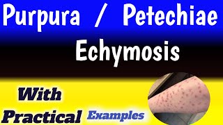 petechiae vs ecchymosis vs purpura [upl. by Britteny]