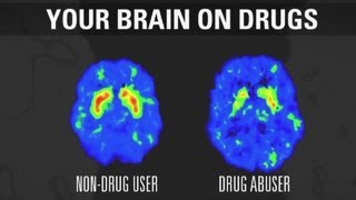 How addiction changes your brain [upl. by Asusej]