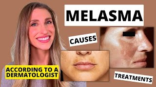 Best Melasma Treatment Dermatologist Explains Melasma Causes At Home Treatments amp More [upl. by Heron926]