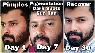 Do you have Dark Spots Pigmentation Just follow this for 100  gauranteed Result 👍  Tamil [upl. by Nnylyrehc573]