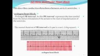 Principles of ECG quotelectrocardiographyquot Part 11 [upl. by Rebma299]