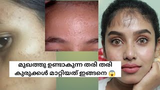 14 days challenge  How to Remove Tiny bumps at home  tiny bumps malayalam  glamyganga [upl. by Haem]