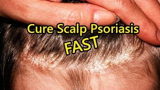 Scalp Psoriasis Home Remedies  How to Cure Scalp Psoriasis FAST [upl. by Lesh]