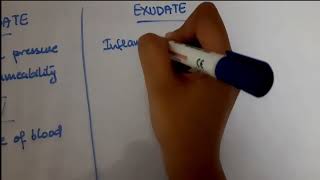 Pleural Effusion  EXUDATE vs TRANSUDATE  Lights criteria [upl. by Offen166]