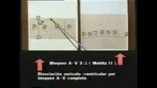 31 Semiología Médica de Lasala El examen físico del aparato cardiovascular 33 [upl. by Etnemelc539]