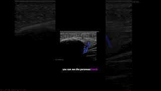 ultrasound Guided Interventions Cases Peroneus Brevis Enthesiophyte fyp sportsdoctor [upl. by Keener685]